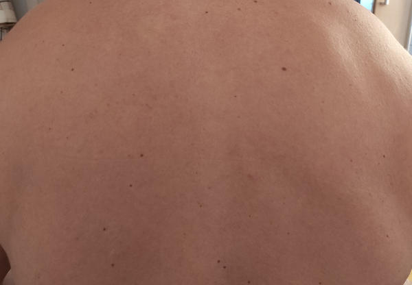 Отсутствие аллергической реакции на средство Лютоня