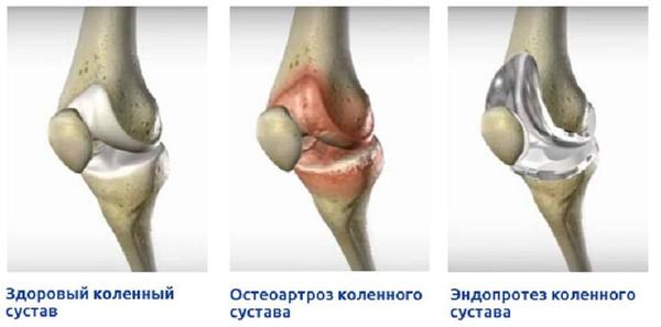Эндопротезирование позволяет избежать боли и сохранить активный образ жизни