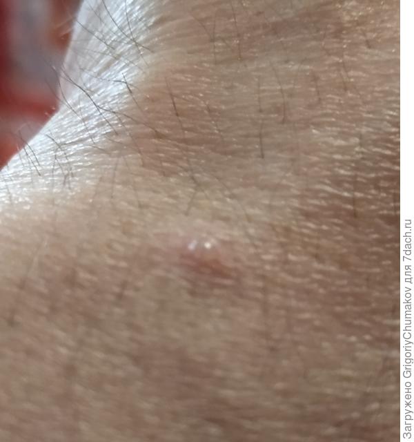 Крупным планом свежий ожог