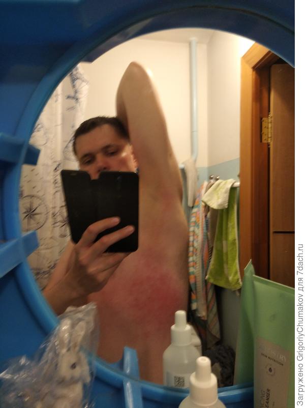 Вот так от бока сыпь поднималась в подмышку