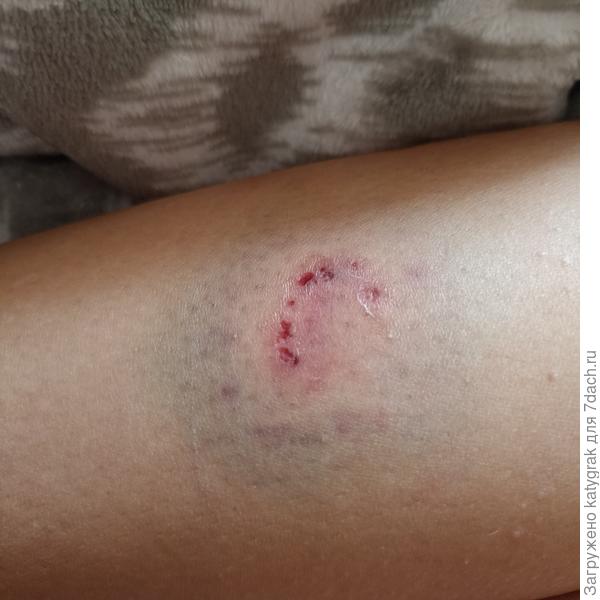 Укус собаки