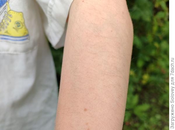 Укусов нет!