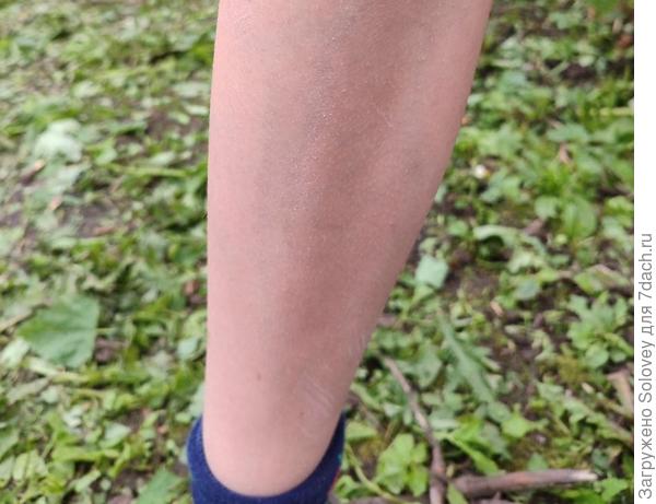 Укусов на ноге нет